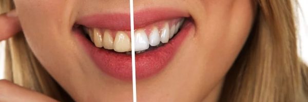 color dientes