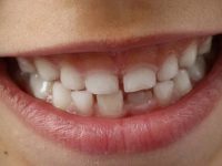 sonrisa infantil
